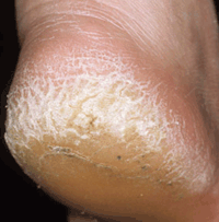 Cracked Dry Heels