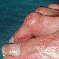 Hammertoe Deformity