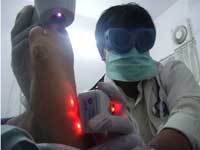 Laser Treatment