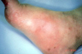 Charcot Foot Complication of Diabetes
