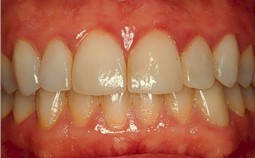Chronic infection and swelling of Gums